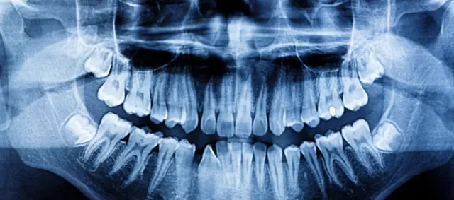 Panoramic OPG dental X-ray of the teeth and jaws